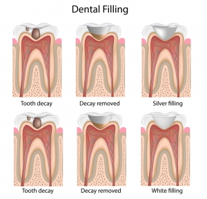 White Fillings Tooth Decay